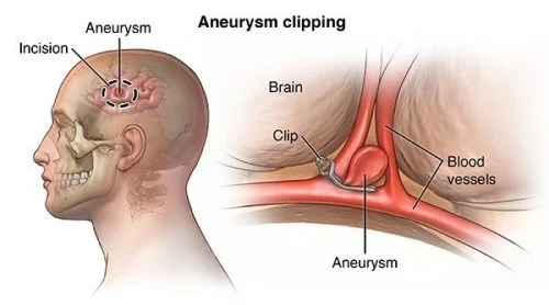 Inside Brain Aneurysms: A Comprehensive Guide to Market Strategies and Regulatory Dynamics | DLI