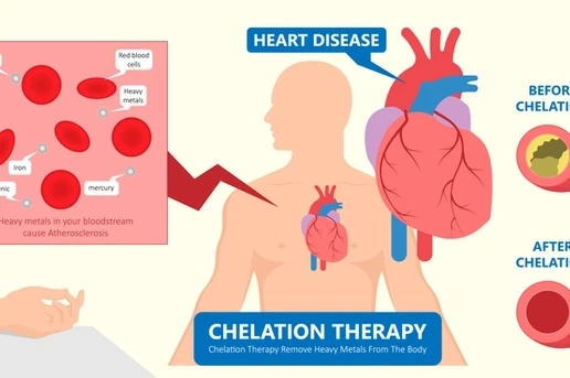 The Benefits of Chelation Therapy and Finding the Right Oral Chelation Supplements
