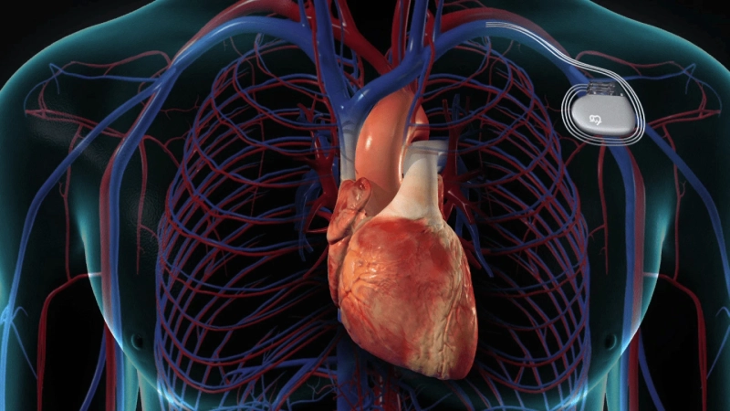 Cardiac Pacemakers: Market Strategies and Developments