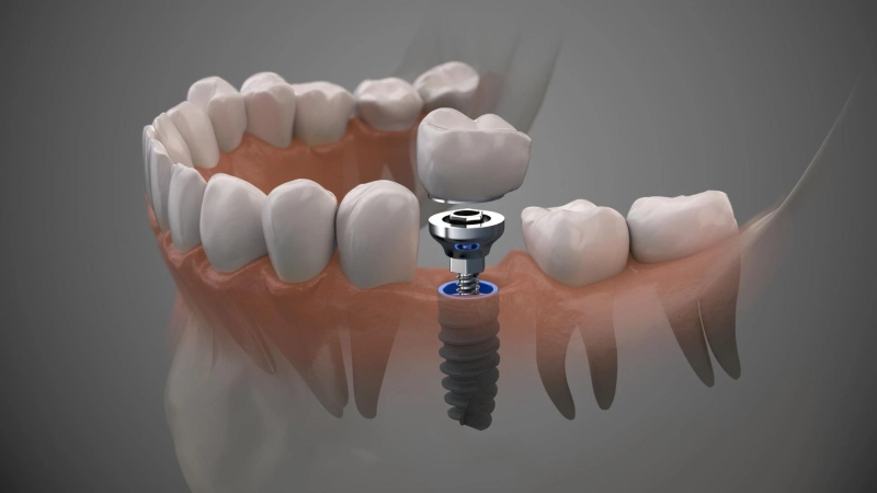 Dental Care Dental Implants for Fixed Teeth Fast
