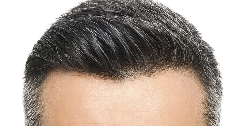 Tips To Find The Best Hair Transplant Clinic in Kolkata