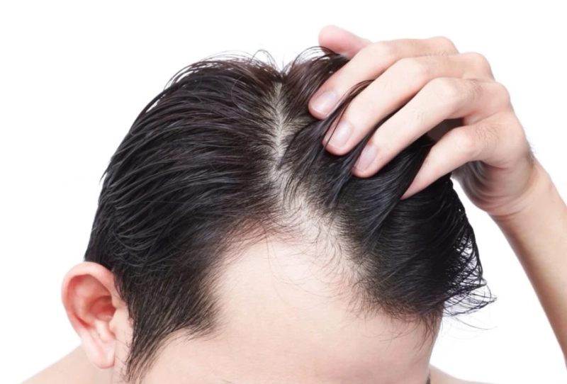 What is PRP Hair Restoration? Explain!
