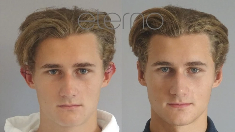 Ear Correction and Eyebrow Lift Surgery in Lucknow