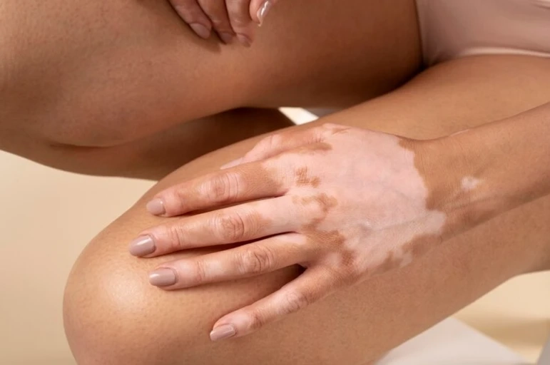 Realistic Vitiligo Pigment Recovery: What Homeopathic Care Can Achieve