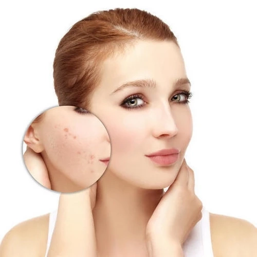 Laser Acne Scars Treatment