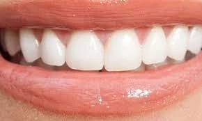 Everything You Need to Know About Teeth Bleaching