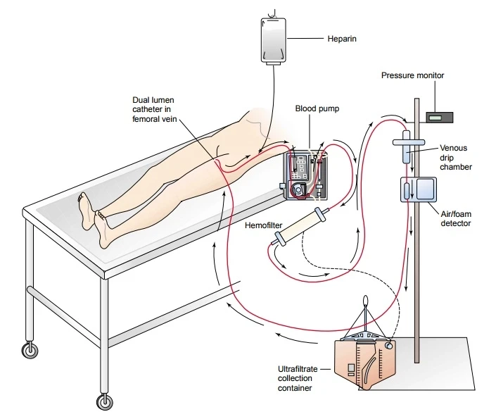 Qualitative Insights on Expansion of Continuous Renal Replacement Therapy Market for 2021-2028
