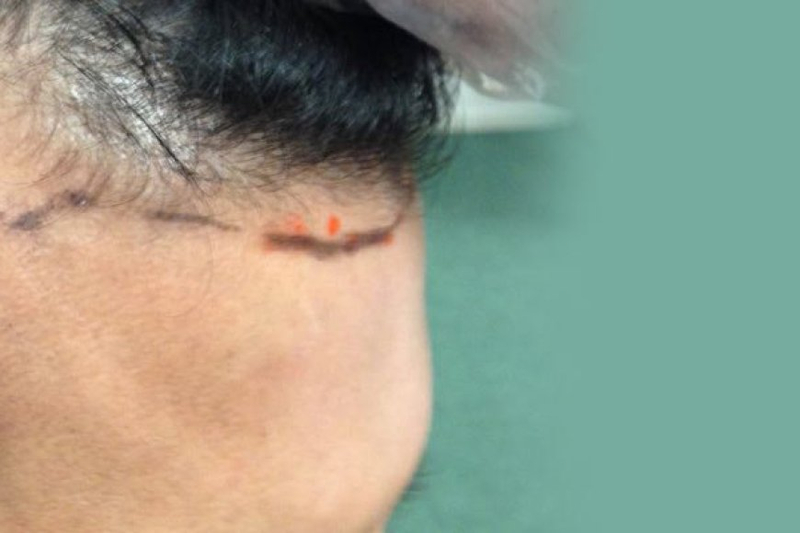 How Long Does A Hair Transplant Take To Heal?