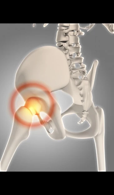 Types of Hip Replacement Surgeries and their costs