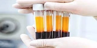 United States Platelet Rich Plasma Market Analysis 2021, Size, Share, Trends and Forecast 2026