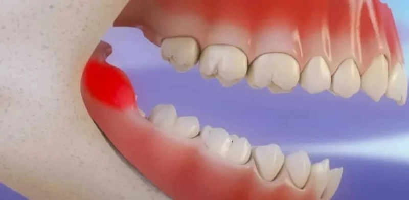 Wisdom Tooth Removal in Singapore: What You Need to Know
