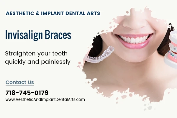 Align Your Teeth with the Help of Invisalign Braces