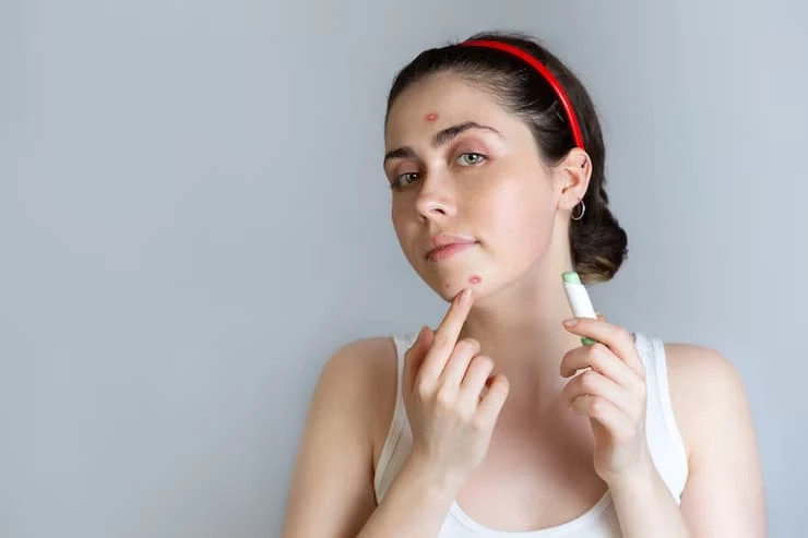 Acne Marks Removal Creams for Every Skin Type: The Ultimate Guide