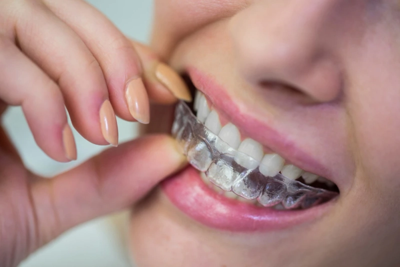 How Does Invisalign Work? A Comprehensive Guide