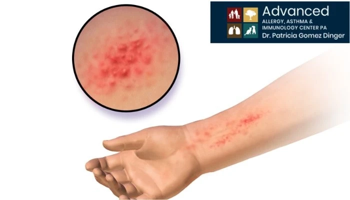 Beneficial Of Allergy And Asthma Center Of Texas