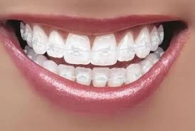 دعامات الأسنان الشفافة وكل ما يتعلق بها