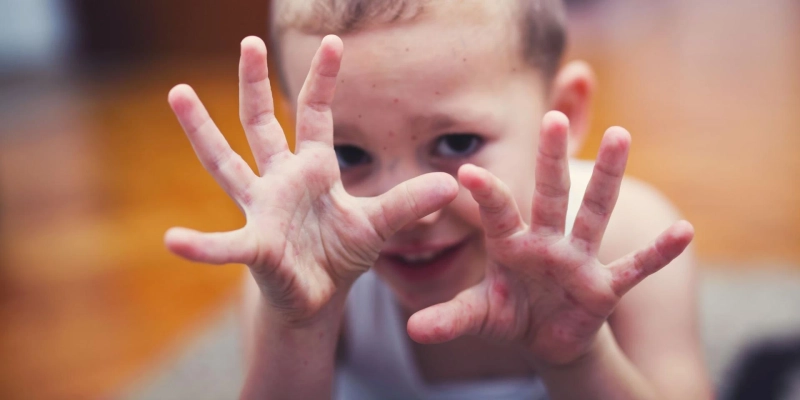 Hand, Foot, and Mouth Disease: Signs Parents Shouldn’t Ignore