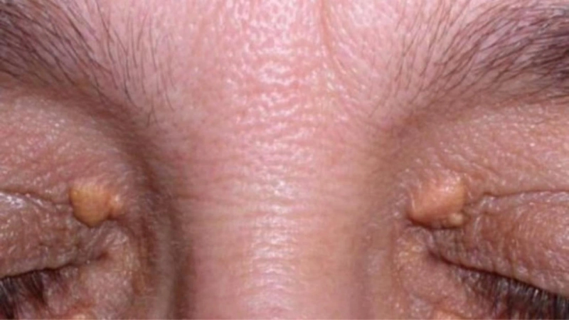What is Xanthelasma and How Can It Be Removed