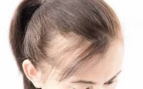 Hair Transplant Surgery in Dubai & UAE | Royal Clinic
