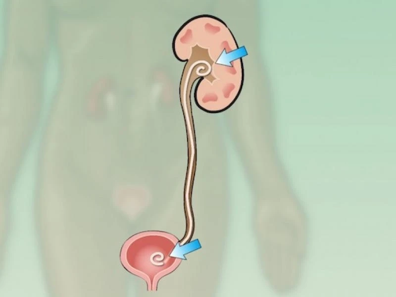 A Thin, Flexible Tube Called A Ureteral Stent Holds Open The Ureters