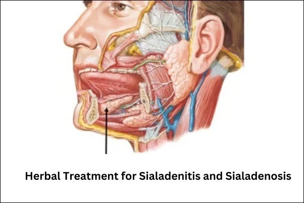 Natural Ayurvedic Treatment for Sialadenitis and Sialadenosis – Causes, Symptoms & Herbal Remedies
