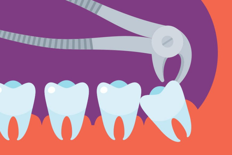 The Wisdom Tooth Odyssey: Understanding Extraction