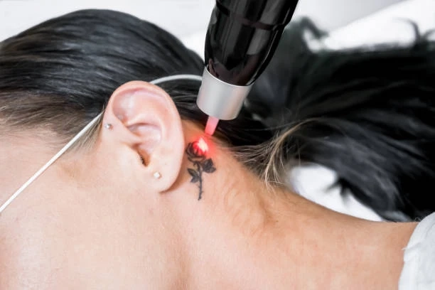 Laser Tattoo Removal Complements Cover-Up Tattoos