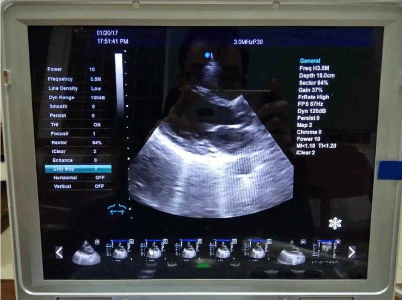 What Is A Color Doppler Ultrasound System