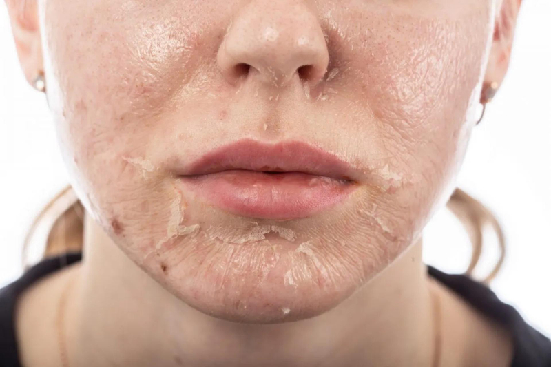 Achieve Radiant Skin: Chemical Peel Benefits