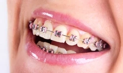 Traditional Metal Braces Appointment Guide: What Happens During Each Orthodontic Visit
