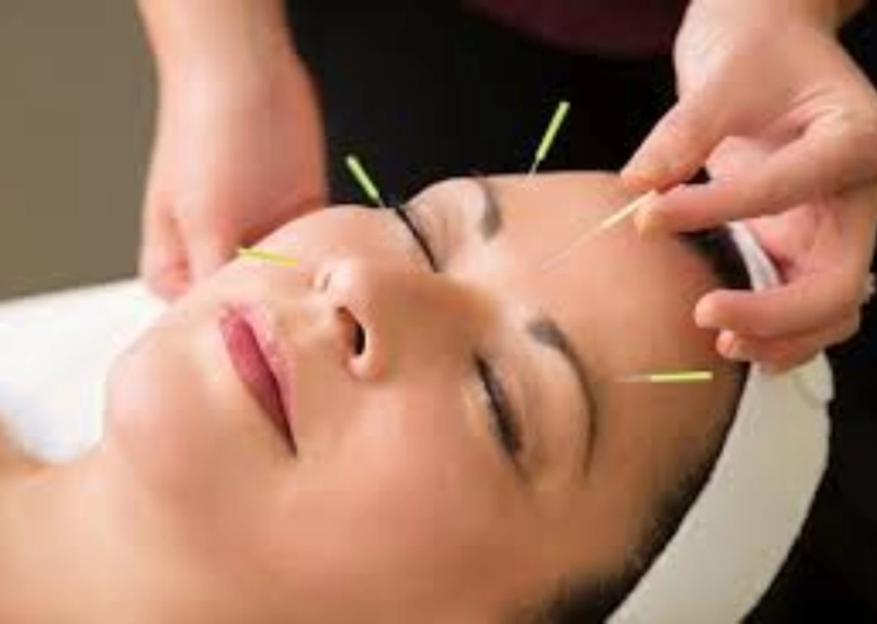 Acupuncture for Hormonal Acne: A Natural Path to Clearer Skin