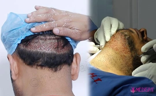 Explain The Significance of Body Hair Transplant