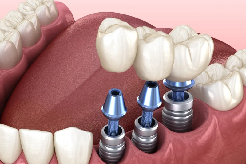 Finding Hard In Getting Best Dental Implants: Visit Tallahassee Fl
