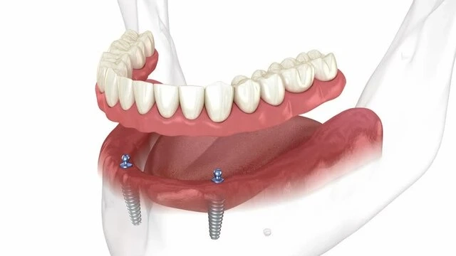 Overdenture in Hadapsar: Procedure, Cost & Benefits Explained