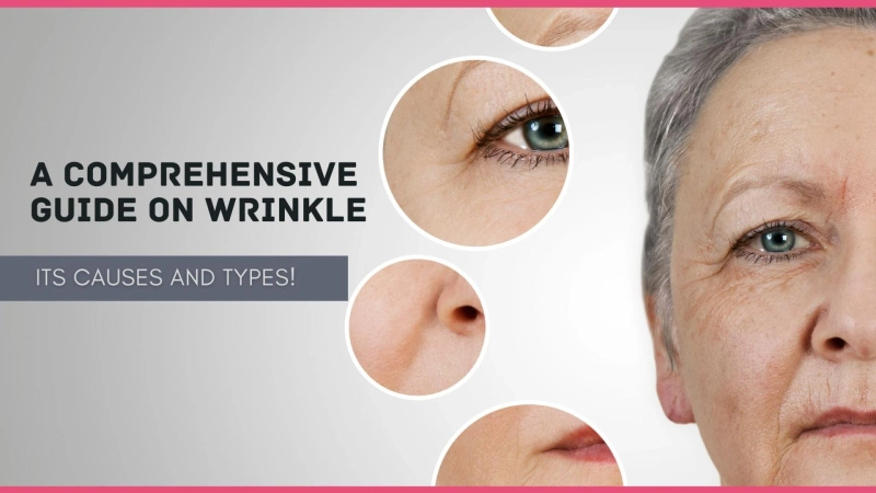 A Comprehensive Guide on Wrinkle, Its Causes and Types!