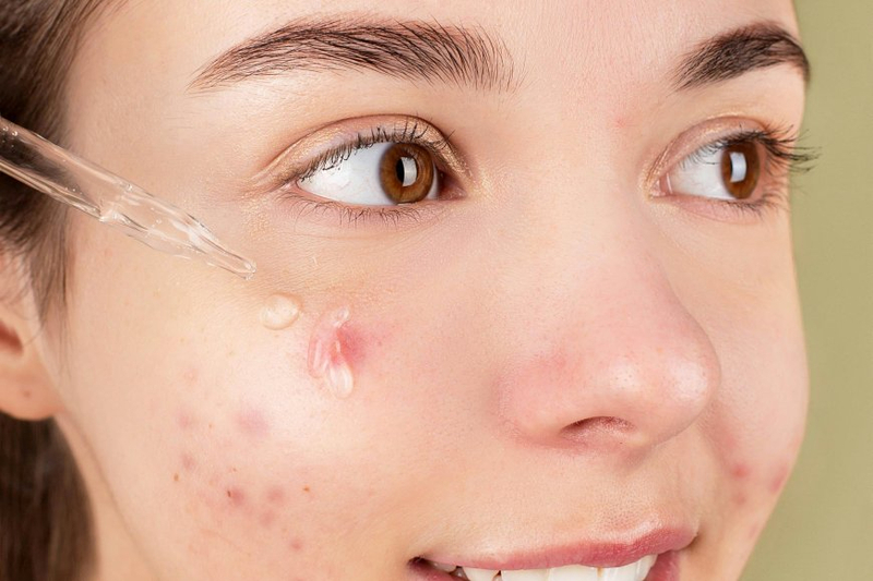 Balancing My Life: A College Student's Journey with Acne and Liftera Hifu Treatment