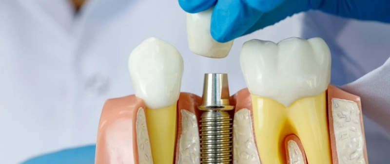 The Best Dental Implants: A Permanent Solution For Missing Teeth