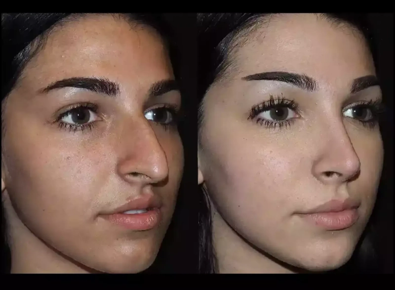 Can Septoplasty in Dubai Be Done Without External Scars?