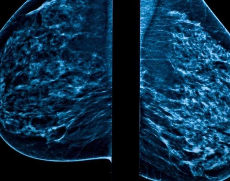 What is a mammogram