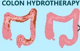 What To Do Before A Colon Hydrotherapy Session | Medical Massage & Detox