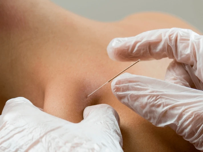 Pro-Athlete Recovery Secrets: From Endermologie to LPG