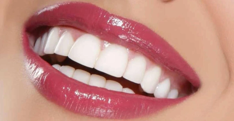 Expats: Composite Veneers Dubai Price Guide