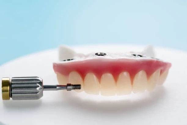 Implant Dentures: A Long-Term Solution for Missing Teeth