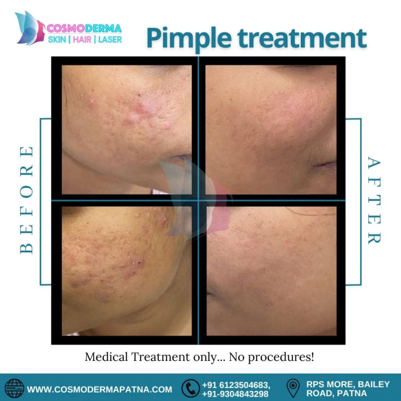 Say Goodbye to Pesky Acne: Effective Acne & Acne Scar Treatment for Clear, Healthy Skin!