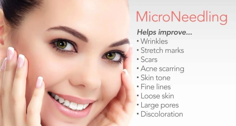 Quick Guide to Microneedling: Why You Need to Try It