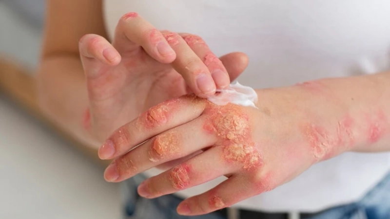 Eczema Explained: Symptoms, Causes, and Treatment Options
