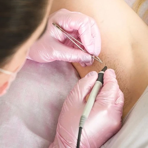 Teen Laser Hair Removal in Islamabad: Is It Too Early?