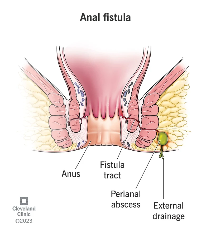 Is a Permanent Fistula Cure Possible? Here’s What Doctors Say