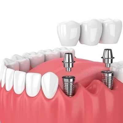 Cheapest Dental Implants: A Comprehensive Comparison for Savvy Consumers