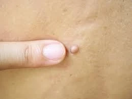 Say Goodbye to Skin Tags: Top Skin Tag Removal Treatment Options for You